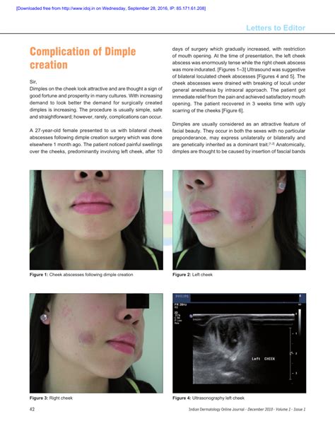 Pdf Complication Of Dimple Creation