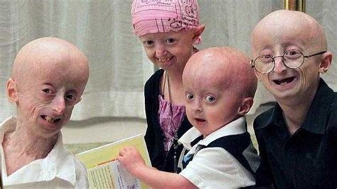 Progeria Nedir Belirtileri Nelerdir 2022