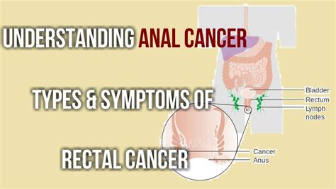Understanding Anal Cancer Types And Symptoms Of Rectal Cancer Youtube