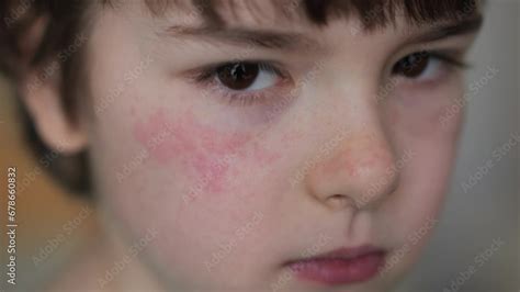 Stockvideon Boy Has Dry Red Skin And Scratching Her Face Child