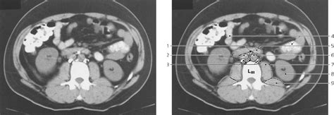 Lymphatics Radiology Key