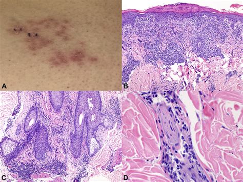 Lichenoid Granulomatous Dermatitis Revisited A Retrospective Case