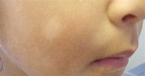 Pityriasis Alba White Spots On Face Of Child Key To Perfect Health