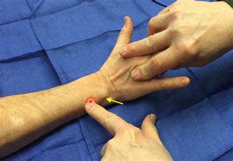 Extensor Carpi Ulnaris Ecu Tenderness Hand Surgery Resource