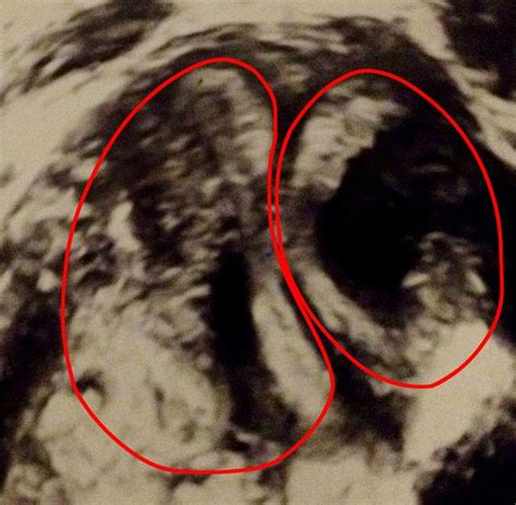 woman born with two vaginas two wombs and two cervixes defies odds to become mum mirror online