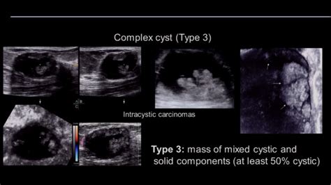 Breast Ultrasound Complicated Vs Complex Cyst Youtube