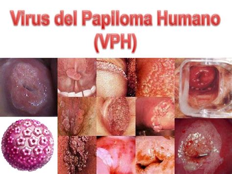 Virus Del Papiloma Gonorrea Virus Del Papiloma Gonorrea My Xxx Hot Girl
