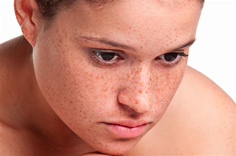 Penyebab munculnya bintik hitam ini biasanya dikarenakan adanya kelebihan sekresi melanin pada kulit wajah. Cara Menghilangkan Bintik Hitam Pada Muka - Menghilangkan ...