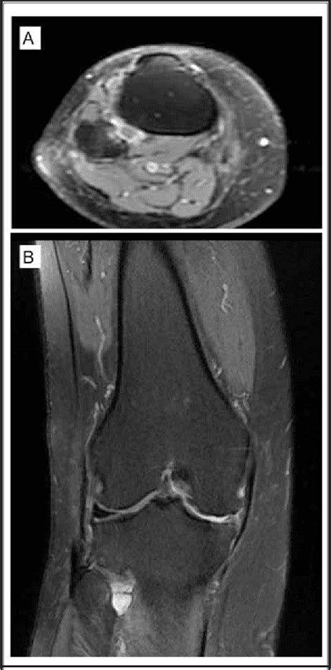 Ganglion Cyst At The Proximal Tibiofibular Joint In A Patient With