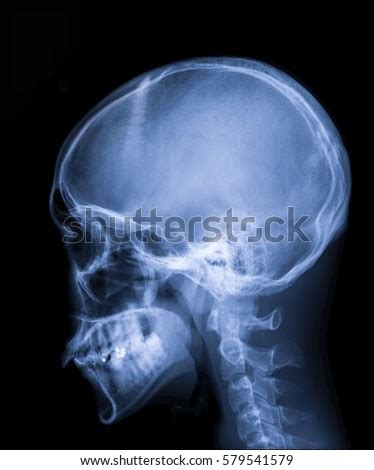 Maybe you would like to learn more about one of these? Film Xray Skull Lateral Show Normal Stock Photo (Edit Now) 579541579 - Shutterstock