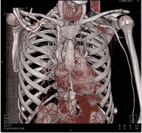 Super Example Of Thrombus In Left Subclavian Artery Nicely Shown In 3d