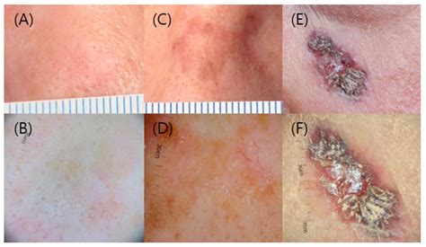 Jcm Free Full Text Treatment Of Actinic Keratosis The Best Choice
