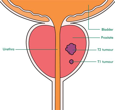 Staging And Grading Early Prostate Cancer Macmillan Cancer Support