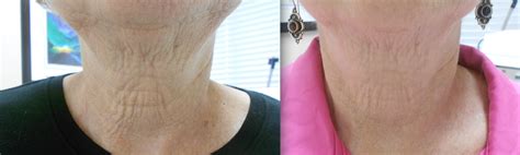 Neck Skin Tightening Before And After Photos