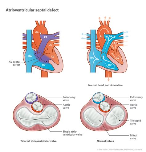 Cardiology Complete Atrio Ventricular Av Septal Defect