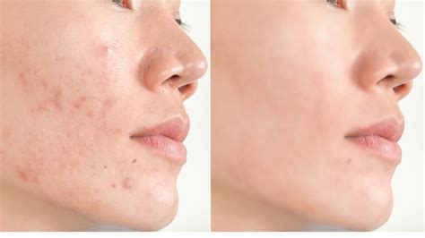Does Acne Go Away On Its Own Or Do You Need An Acne Treatment To Achieve Clear Skin Best