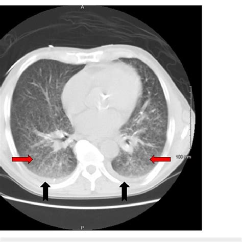 Ct Scan Of The Chest Axial View Lung Window At The Level Of The