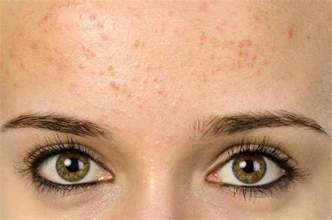 Zap Your Zits How To Treat Hormonal Acne And Get Clear Skin