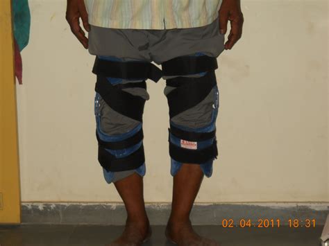 Polycentric Hinge Knee Brace For Bow Legs