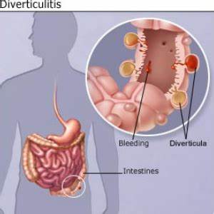 Diverticulitis 9 Home Remedies And Natural Treatments