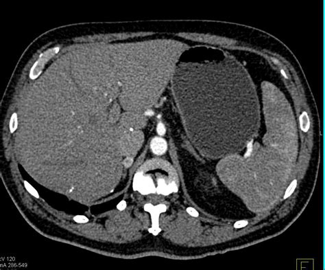 Recurrent Renal Cell Carcinoma With Adenopathy In The Chest And Abdomen