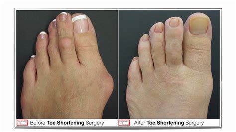 Can You Get Toe Shortening Surgery On The Nhsmail