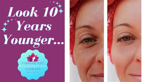 Look 10 Years Younger About Fibroblast Rejuvenation Skin Tightening