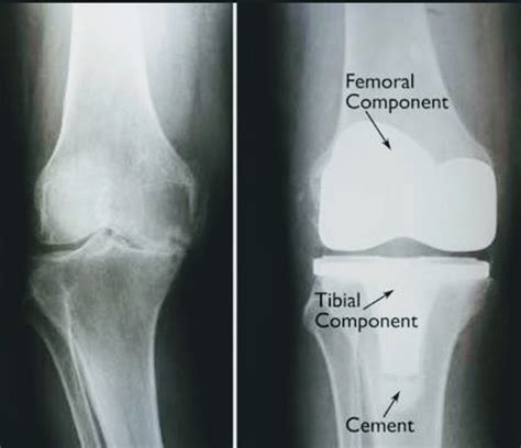 KNEE OSTEOARTHRITIS AND TOTAL KNEE ARTHROPLASTY | Knee replacement, Total knee replacement, Knee 