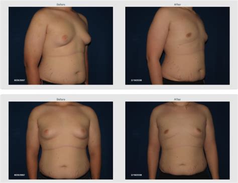 Male Breast Surgery Holzapfel Lied Plastic Surgery