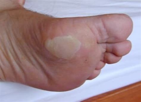 Blisters Causes And Treatment Healdove