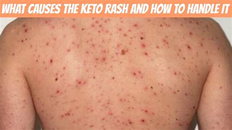 What Exactly Is A Keto Rash And How To Handle YouTube