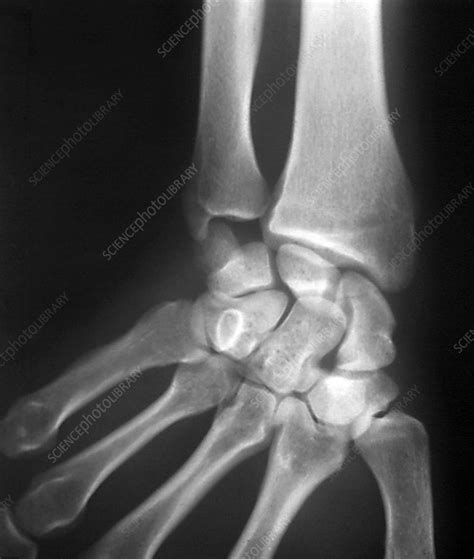 Broken Wrist X Ray Stock Image C0468596 Science Photo Library