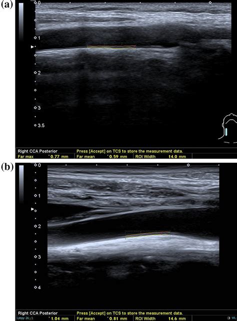 A Longitudinal Ultrasound Of The Right Cca In A 27 Year Old Female