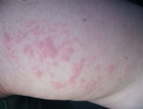 Itchy Skin Rash Medical Pictures