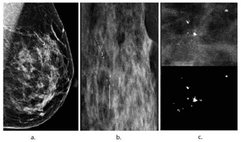 Electronics Free Full Text Mammographic Classification Of Breast Cancer Microcalcifications