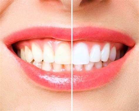 Boost Your Confidence With Teeth Whitening Carolina Dentistry