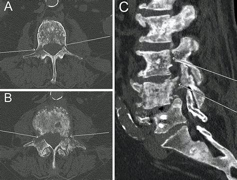 Cureus Stereotactic Vertebroplasty For Spinal Metastases With