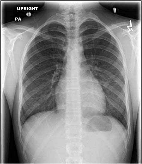 Myopericarditis In A Young Turkish Woman With Heterozygous Familial