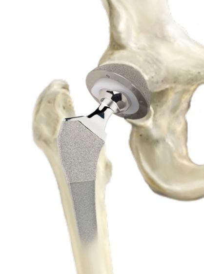 Superpath Total Hip Replacement Chesterfield Shoulder Specialist St Louis