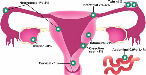 Uncommon Implantation Sites Of Ectopic Pregnancy Thinking Beyond The Complex Adnexal Mass