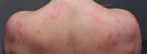 Prickly Heat Heat Rash Causes Home Remedies And Prevention