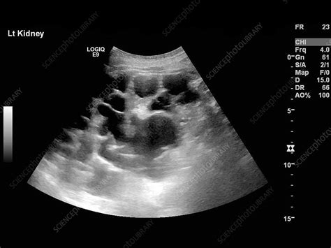 Polycystic Kidneys Ultrasound Scan Stock Image C0177189 Science