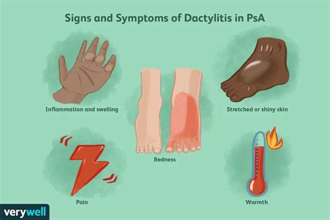 Dactylitis With Psoriatic Arthritis Causes And More