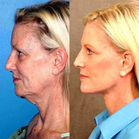 Facelift Amazing Face Lift Before And After Facelift Info Prices