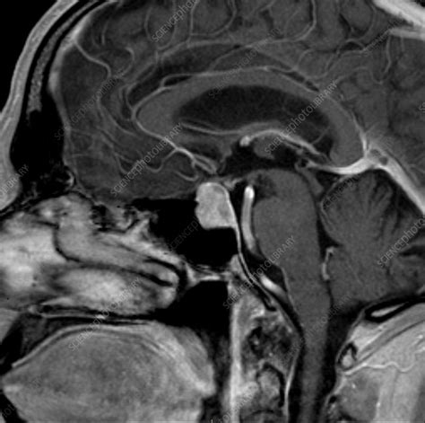 Pituitary Macroadenoma Mri Stock Image C0393570 Science Photo