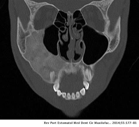 Management Of Fibrous Dysplasia In The Midface Esthetic And Functional