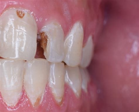 Tooth Decay The Stages Shandon Dental Cork City Dentist