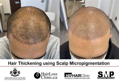 Scalp Tattoo For Thinning Hair For Men And Women Hairtattoo Ca