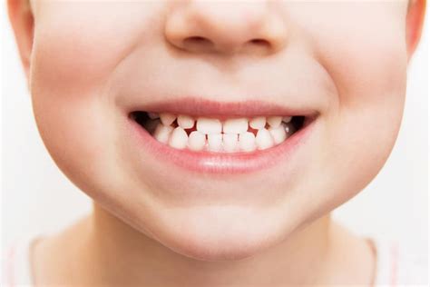 Chalky Teeth In Children Molar Hypomineralisation Symptoms
