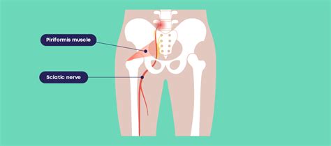 What You Need To Know About Piriformis Syndrome Carl Todd Clinic